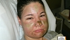 Acid Attack in Vancouver, Wash.