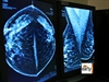 when were digital mammograms invented mammograms