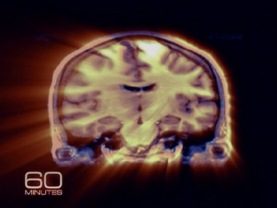 Advancements In Brain Imaging