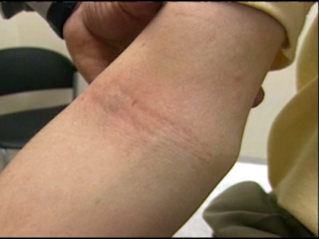 Solution To Eczema