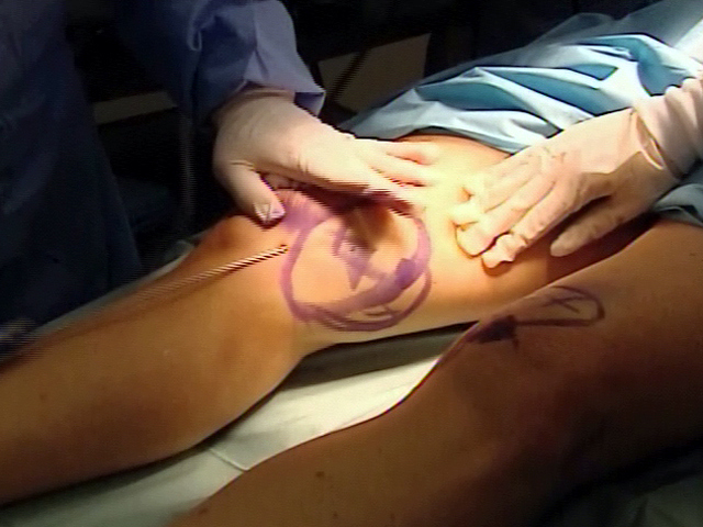 New Liposuction Method