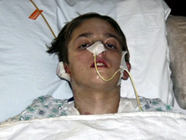 Teen Burn Victim in Recovery