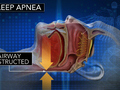 CBS This Morning: Sleep apnea increases risk of heart attack, study finds