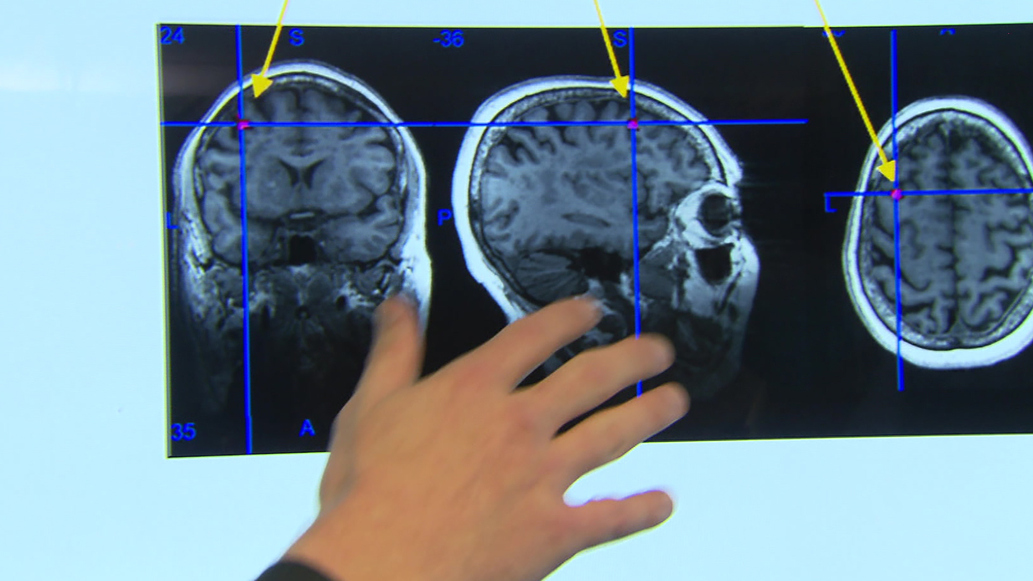 Watch Sunday Morning A promising new treatment for depression Full