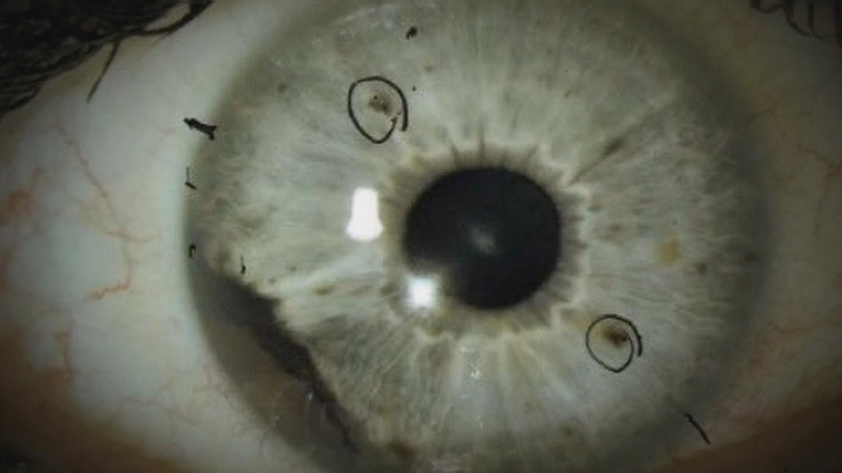 Watch Cbs This Morning Rare Eye Cancer Mystery Full Show On Cbs All Access
