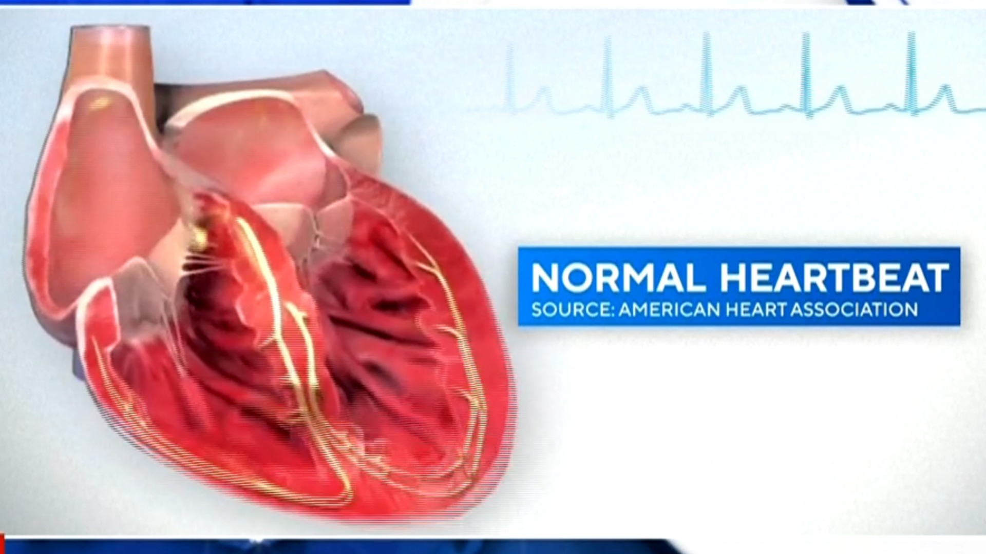 Watch CBS Evening News What could cause Damar Hamlin's cardiac arrest