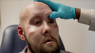 Eye On America : Eye on America: Man receives eye transplant'