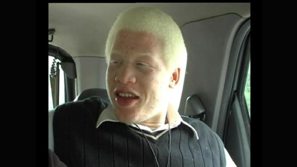 Mi vida - Soy albino