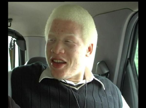Mi vida - Soy albino