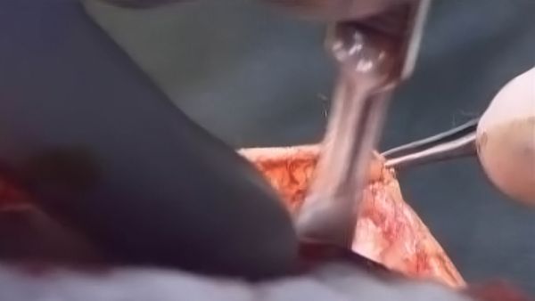 Diagnostic: Inconnnu - Bactérie commune/Souche mortelle