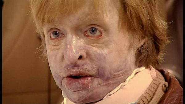 Amazing Lives - Life After Burns