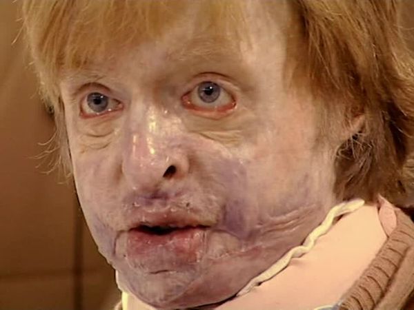 Amazing Lives - Life After Burns