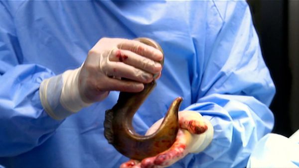 Untold Stories of the ER - Hooked Alive