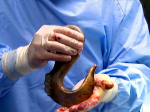 Untold Stories of the ER - Hooked Alive