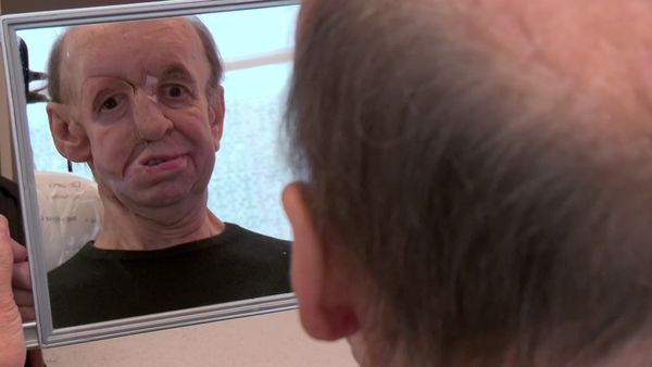 Embarrassing Bodies - Episode Special 1 - Man With Half A Face