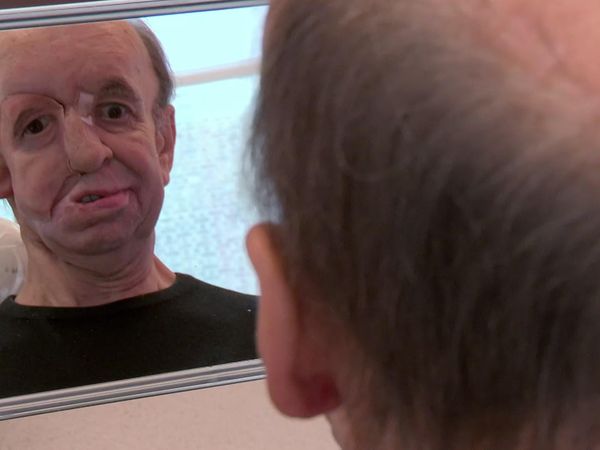 Embarrassing Bodies - Episode Special 1 - Man With Half A Face