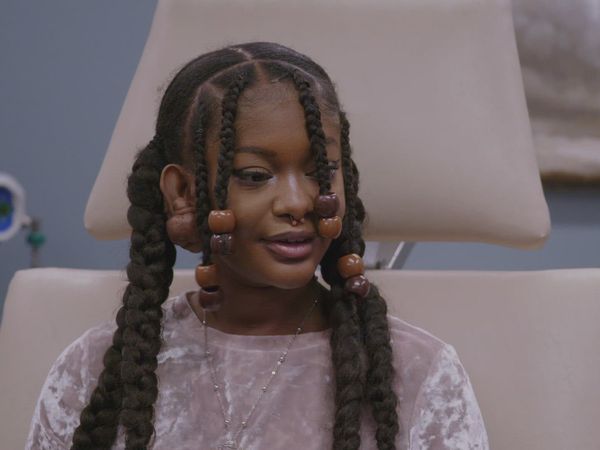 Dr. Pimple Popper: Breaking Out - Superglue to the Rescue